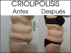 crio antes después ABDOMEN MUJER