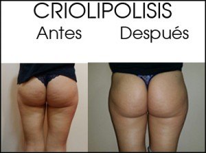 crio antes después NALGAS