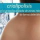 Criolipólisis. Descubre los tratamientos.